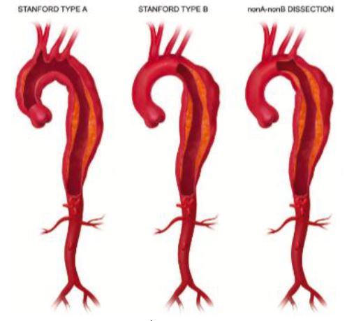 Akūtas aortas disekcijas klasifikācija